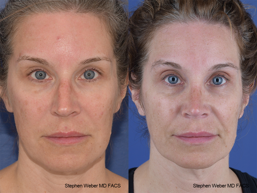 Rhinoplasty Before and After | Weber Facial Plastic Surgery