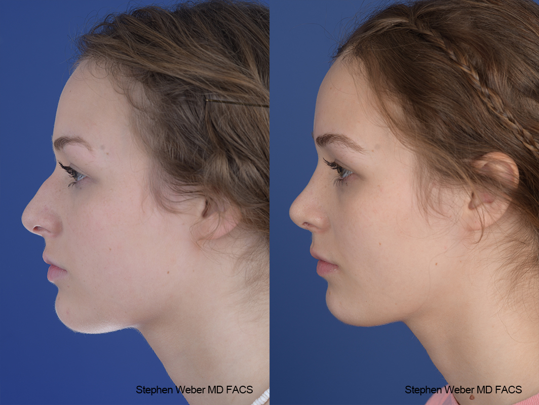 Rhinoplasty Before and After | Weber Facial Plastic Surgery