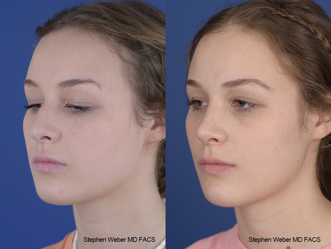Rhinoplasty Before and After | Weber Facial Plastic Surgery