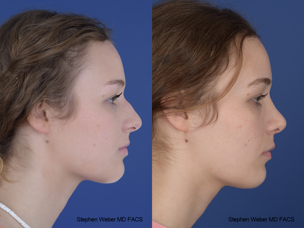 Rhinoplasty Before and After | Weber Facial Plastic Surgery