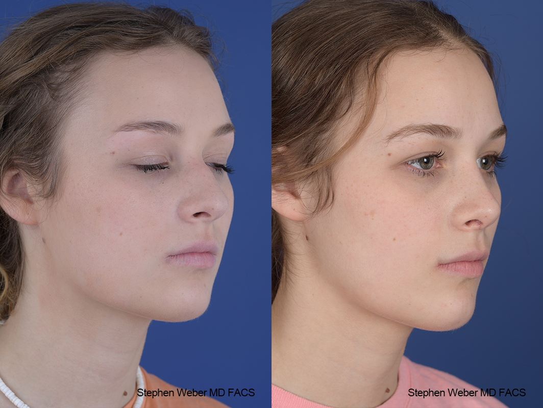 Rhinoplasty Before and After | Weber Facial Plastic Surgery