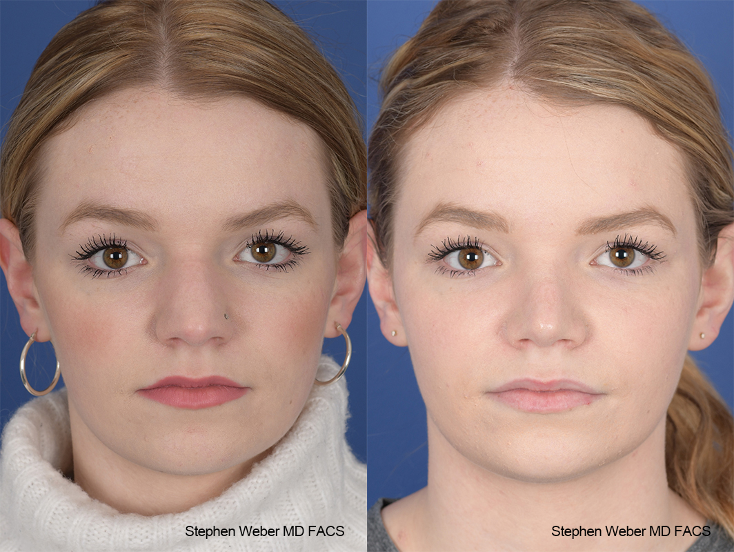 Rhinoplasty Before and After | Weber Facial Plastic Surgery
