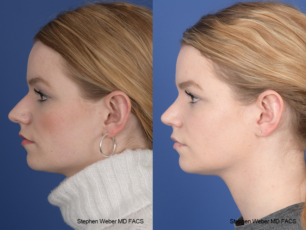 Rhinoplasty Before and After | Weber Facial Plastic Surgery