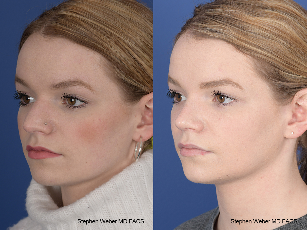 Rhinoplasty Before and After | Weber Facial Plastic Surgery
