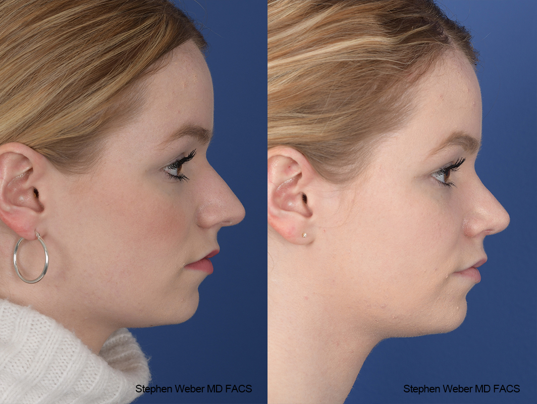 Rhinoplasty Before and After | Weber Facial Plastic Surgery