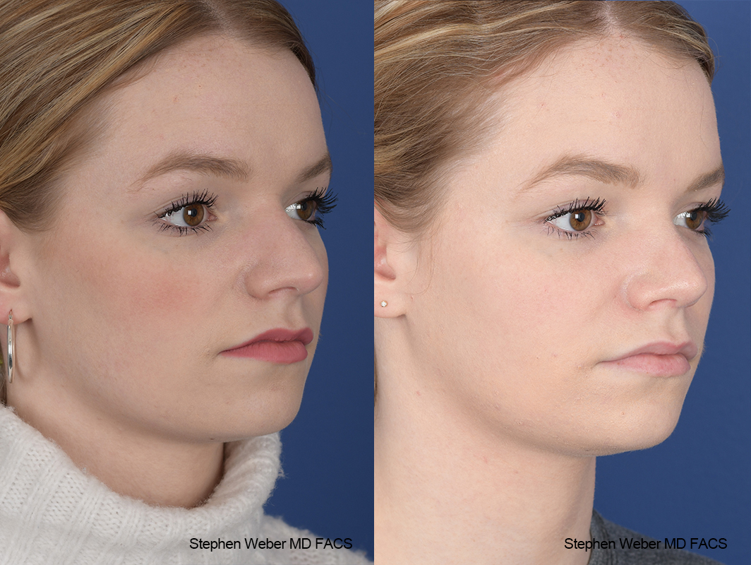 Rhinoplasty Before and After | Weber Facial Plastic Surgery