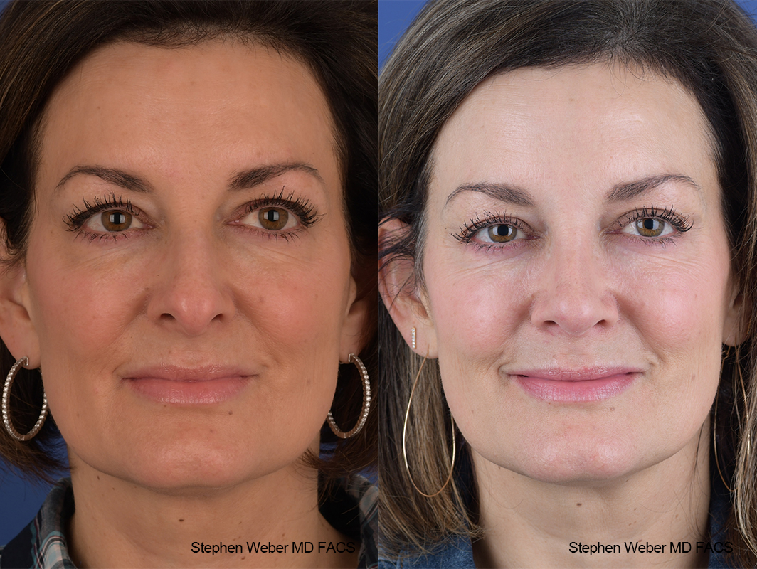 Rhinoplasty Before and After | Weber Facial Plastic Surgery