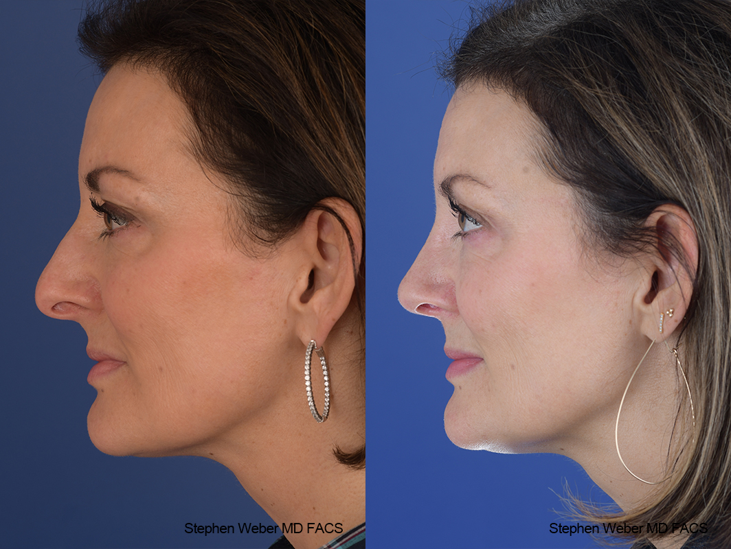 Rhinoplasty Before and After | Weber Facial Plastic Surgery