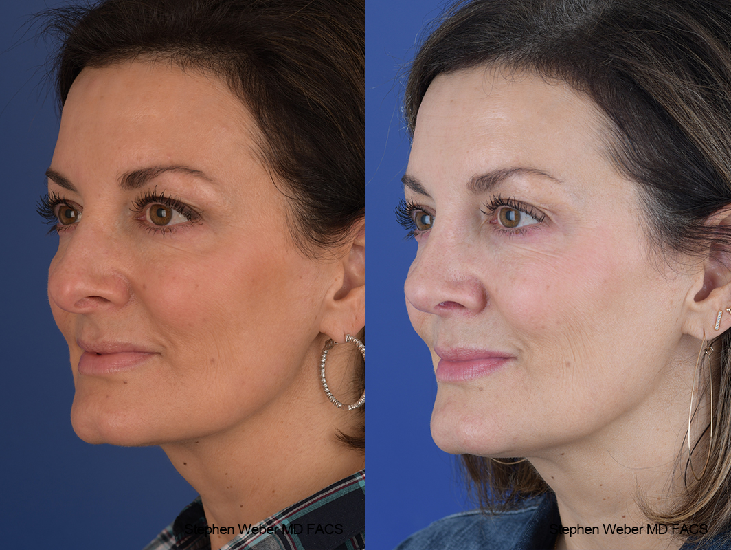 Rhinoplasty Before and After | Weber Facial Plastic Surgery