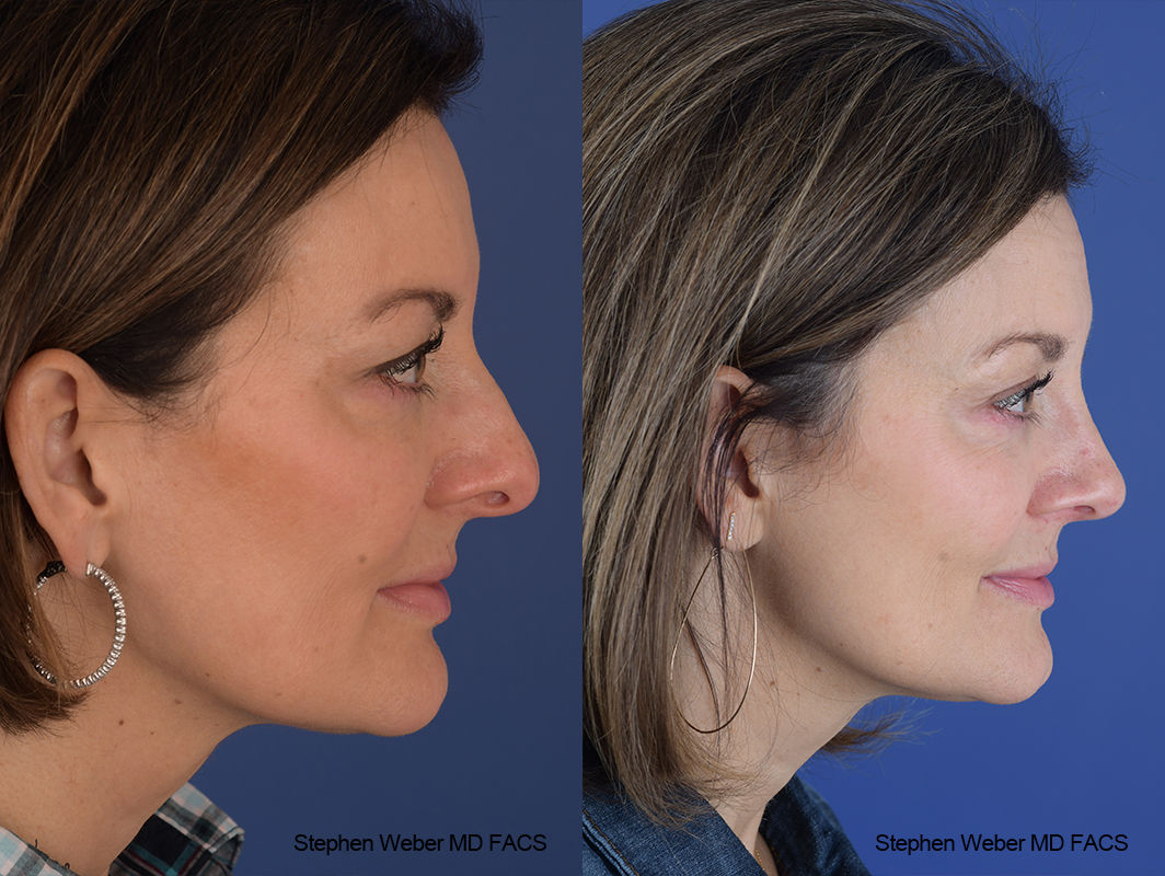Rhinoplasty Before and After | Weber Facial Plastic Surgery
