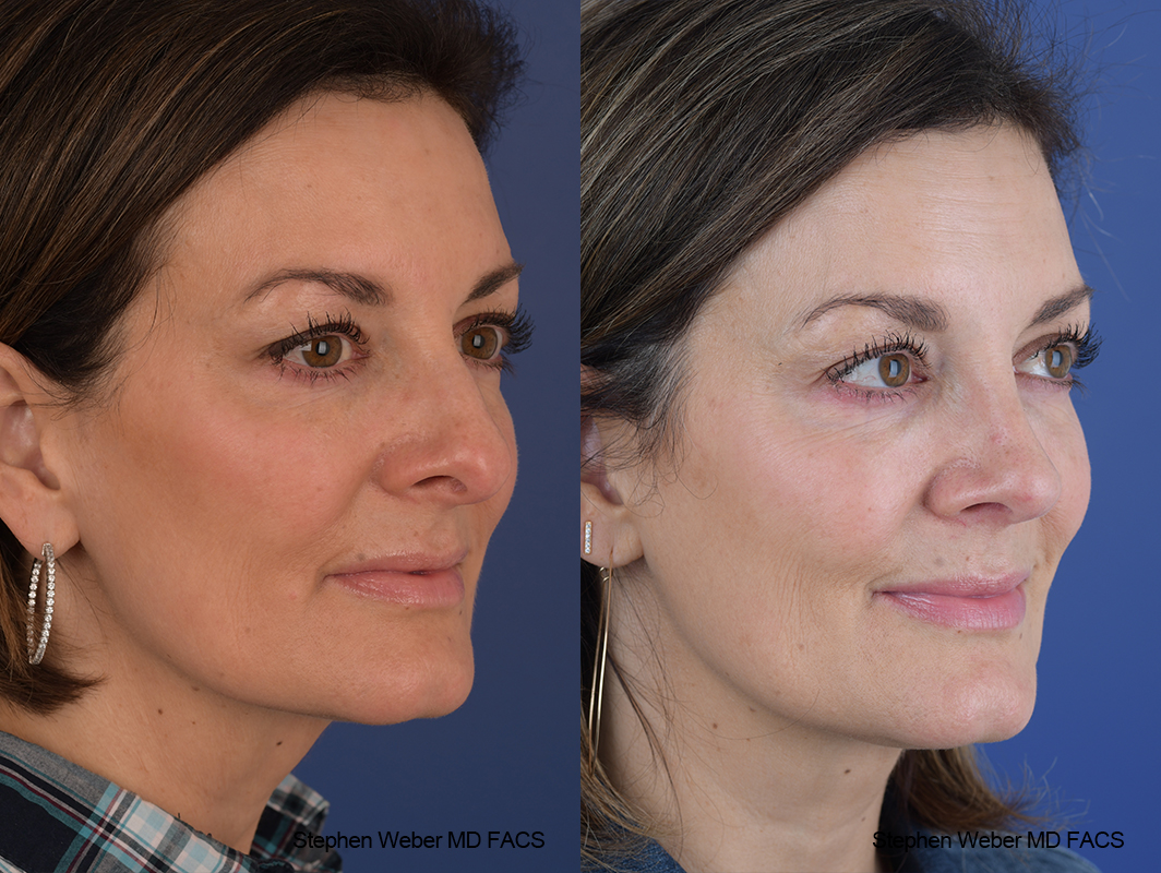 Rhinoplasty Before and After | Weber Facial Plastic Surgery
