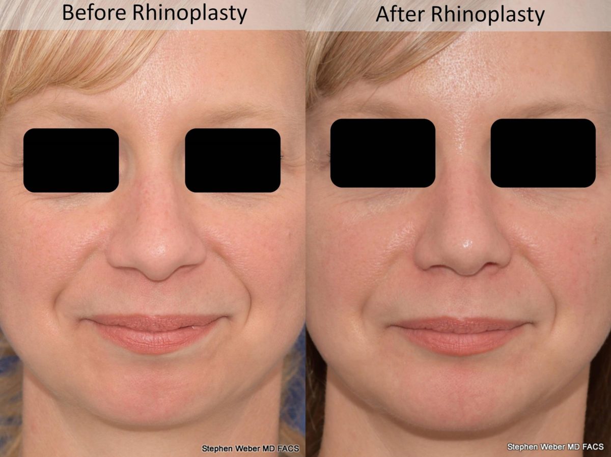 Rhinoplasty Before and After | Weber Facial Plastic Surgery