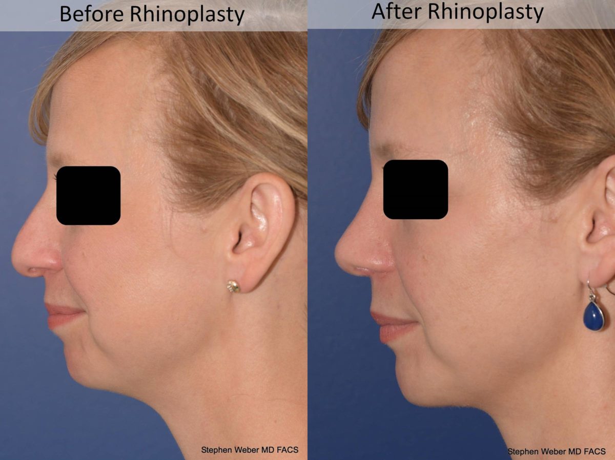 Rhinoplasty Before and After | Weber Facial Plastic Surgery