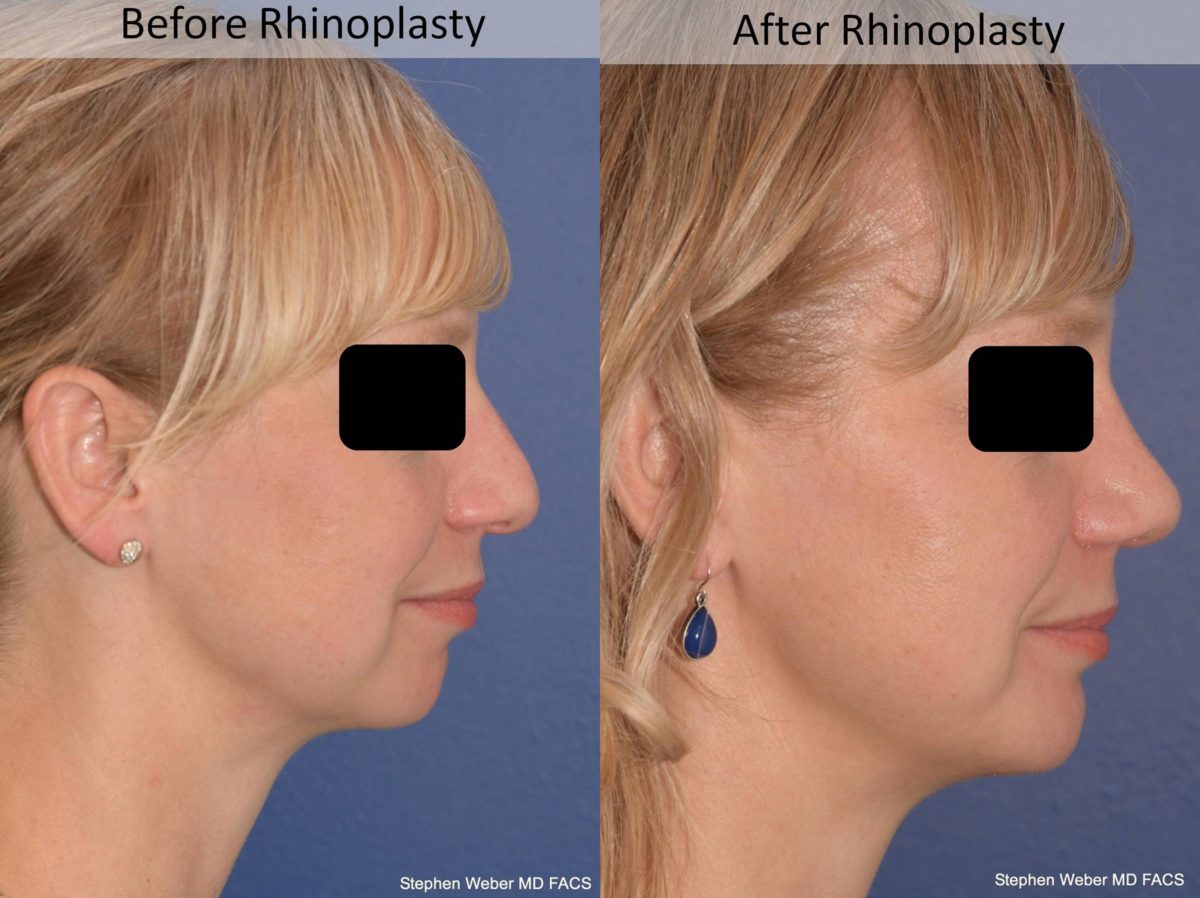 Rhinoplasty Before and After | Weber Facial Plastic Surgery