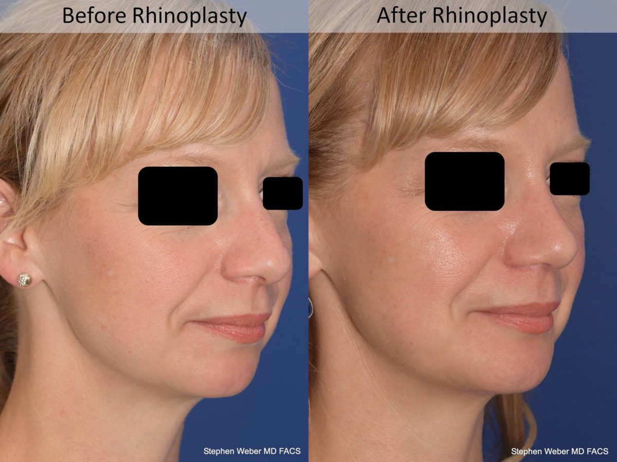 Rhinoplasty Before and After | Weber Facial Plastic Surgery