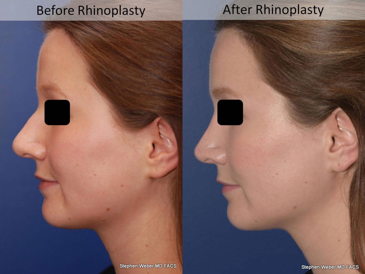 Rhinoplasty Before and After | Weber Facial Plastic Surgery
