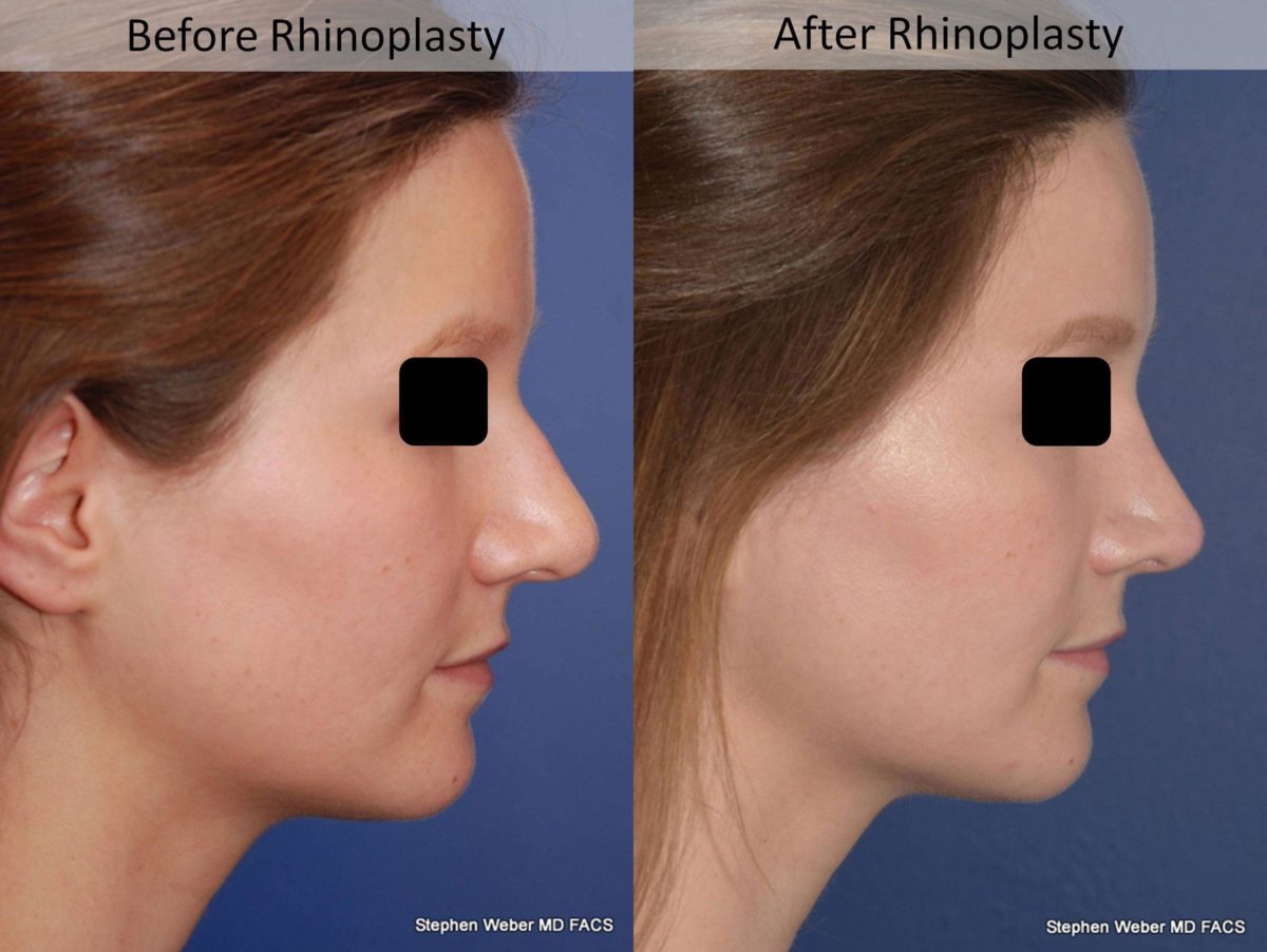 Rhinoplasty Before and After | Weber Facial Plastic Surgery