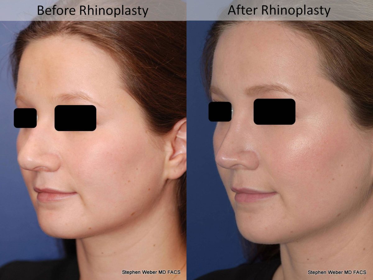 Rhinoplasty Before and After | Weber Facial Plastic Surgery