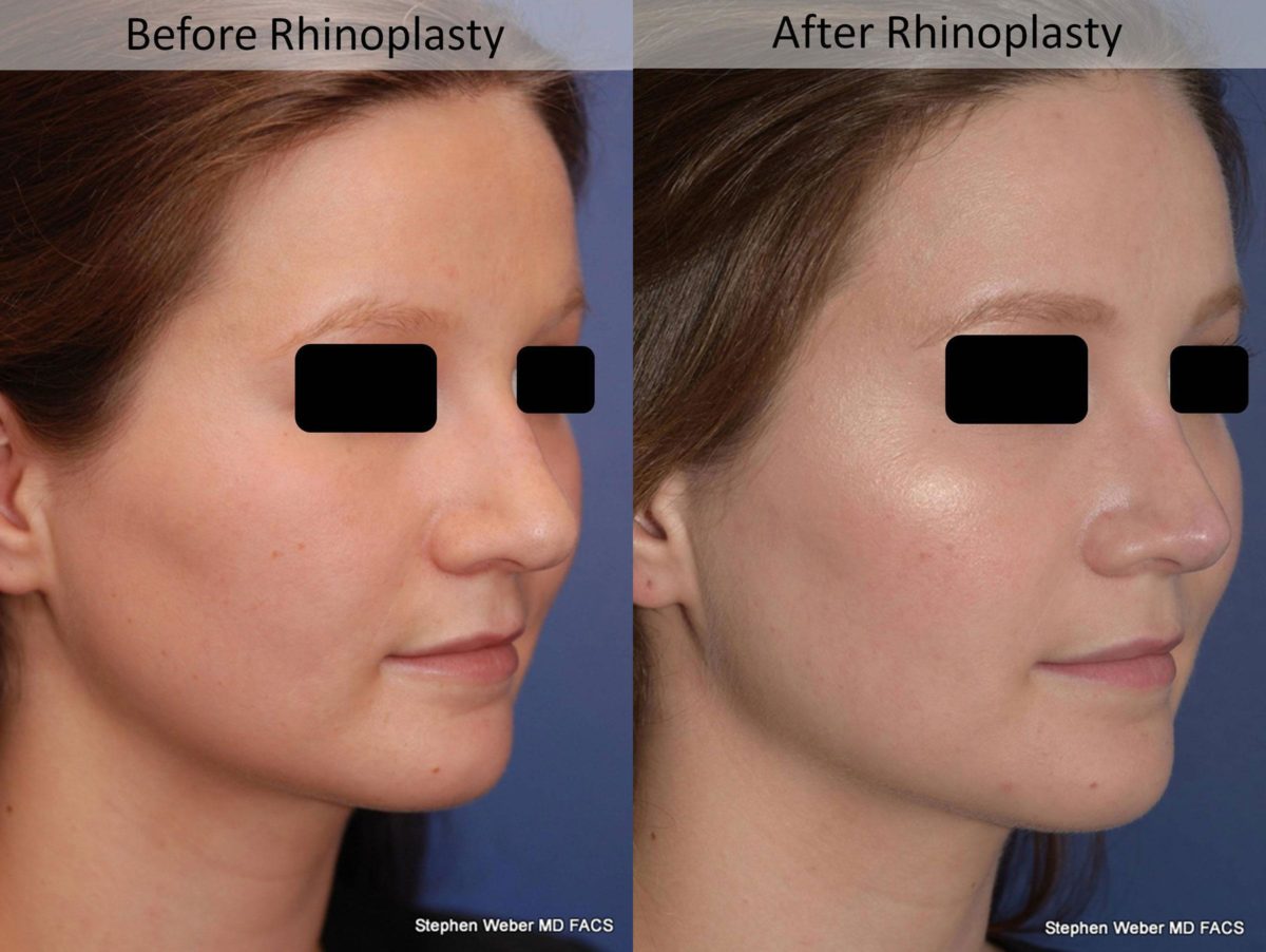 Rhinoplasty Before and After | Weber Facial Plastic Surgery