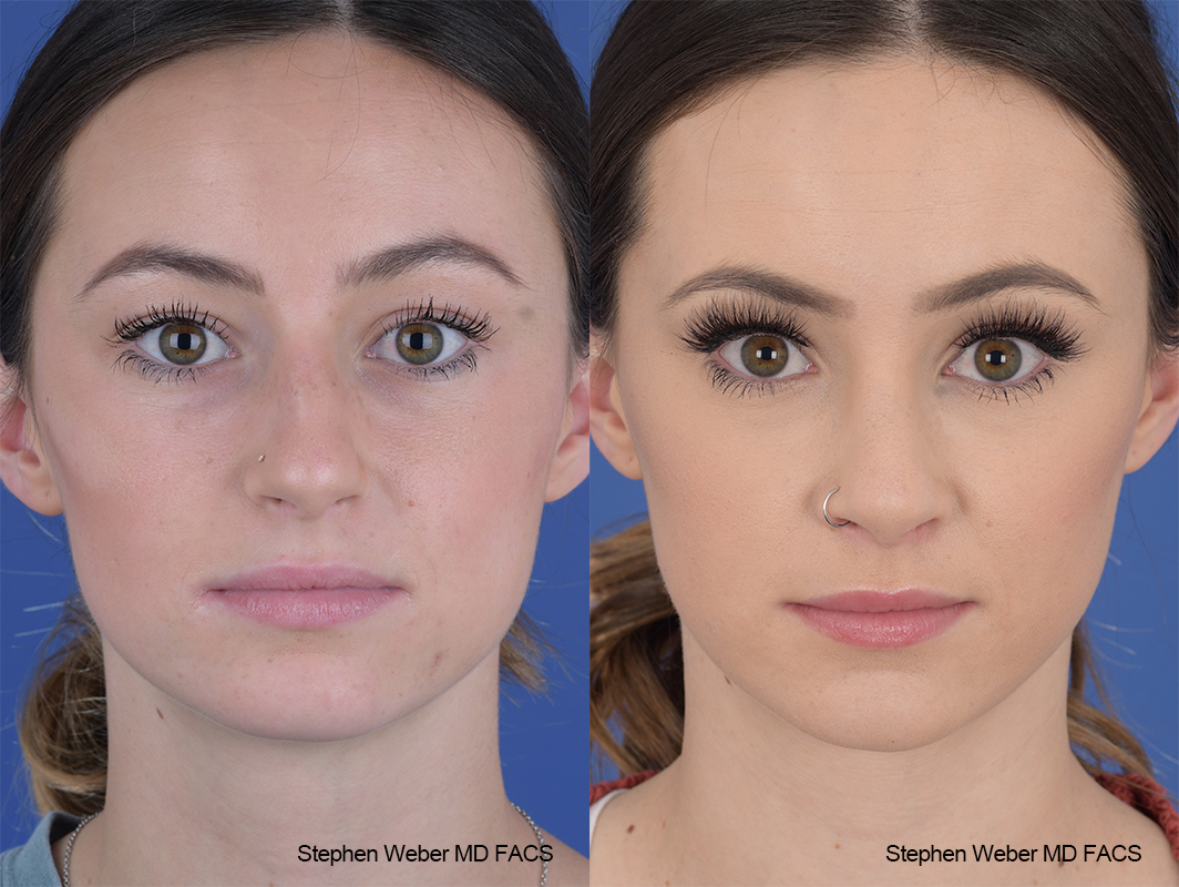 Rhinoplasty Before and After | Weber Facial Plastic Surgery