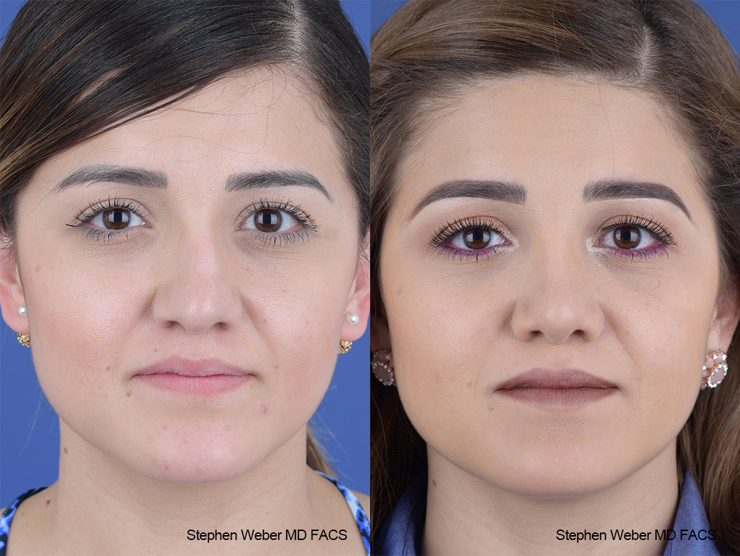 Rhinoplasty Before and After | Weber Facial Plastic Surgery