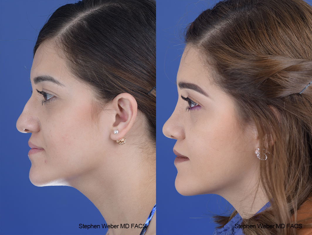 Rhinoplasty Before and After | Weber Facial Plastic Surgery