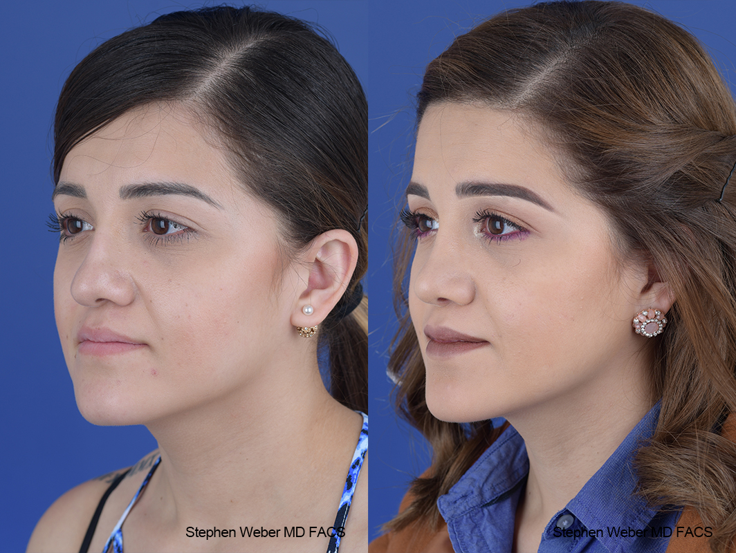 Rhinoplasty Before and After | Weber Facial Plastic Surgery
