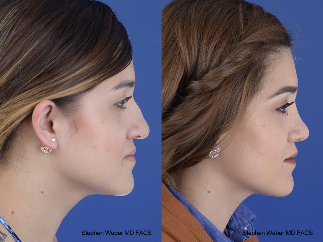 Rhinoplasty Before and After | Weber Facial Plastic Surgery