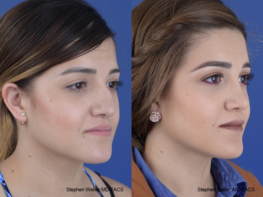 Rhinoplasty Before and After | Weber Facial Plastic Surgery