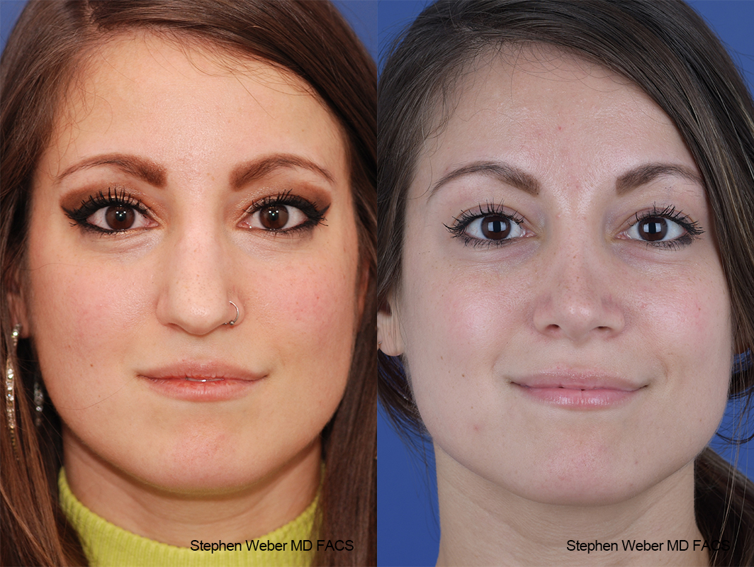 Rhinoplasty Before and After | Weber Facial Plastic Surgery