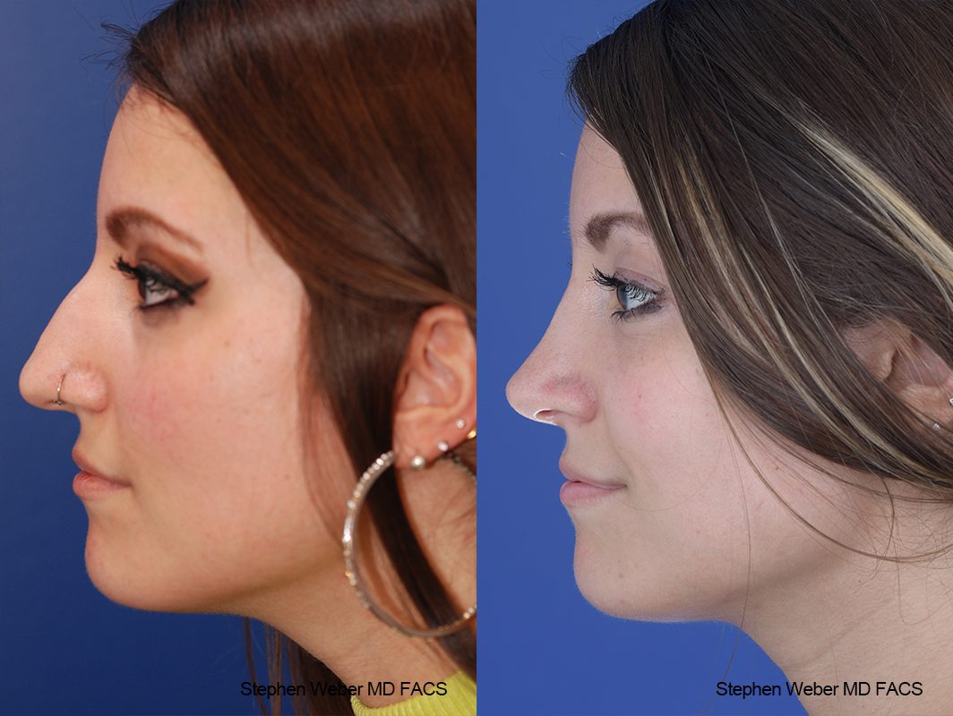 Rhinoplasty Before and After | Weber Facial Plastic Surgery