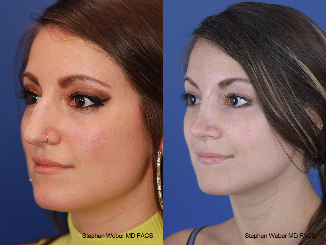 Rhinoplasty Before and After | Weber Facial Plastic Surgery