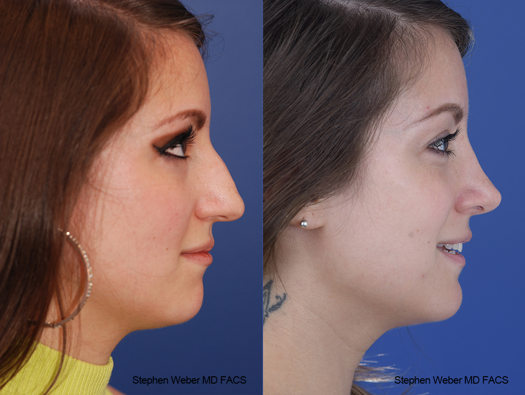 Rhinoplasty Before and After | Weber Facial Plastic Surgery