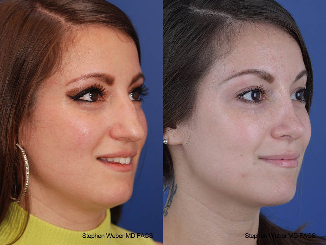 Rhinoplasty Before and After | Weber Facial Plastic Surgery