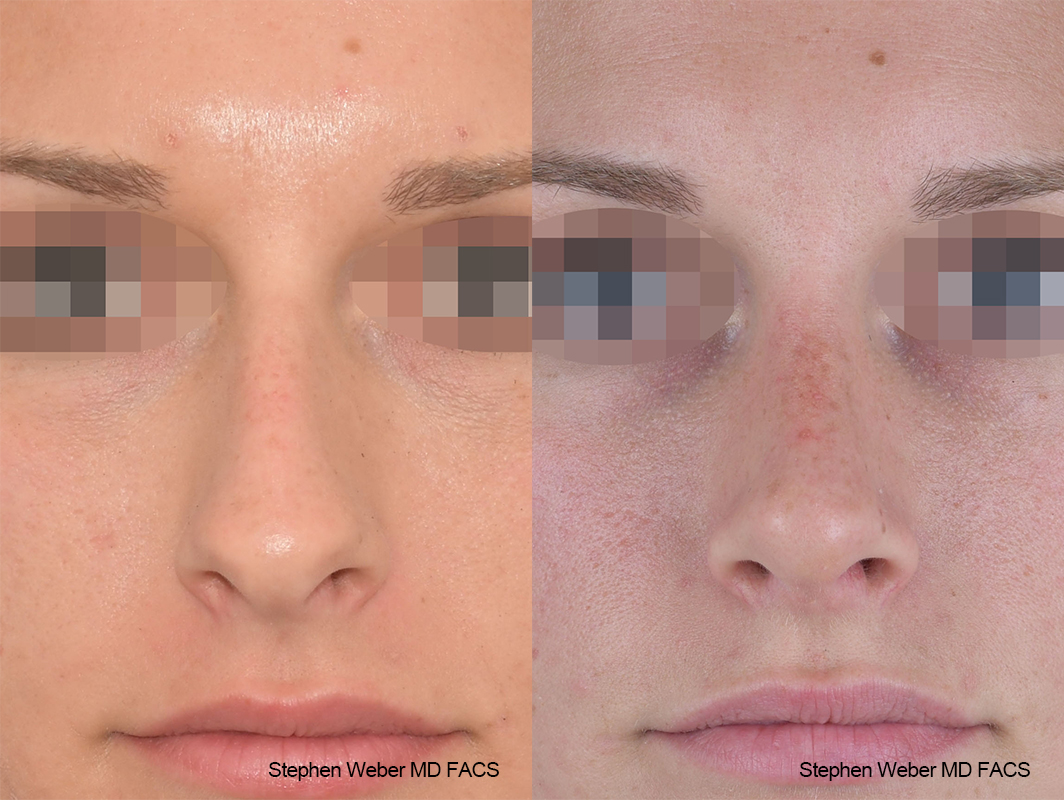 Rhinoplasty Before and After | Weber Facial Plastic Surgery