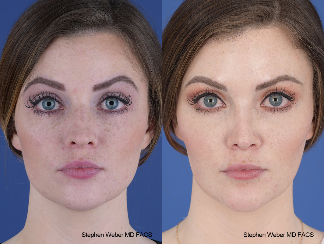Rhinoplasty Before and After | Weber Facial Plastic Surgery