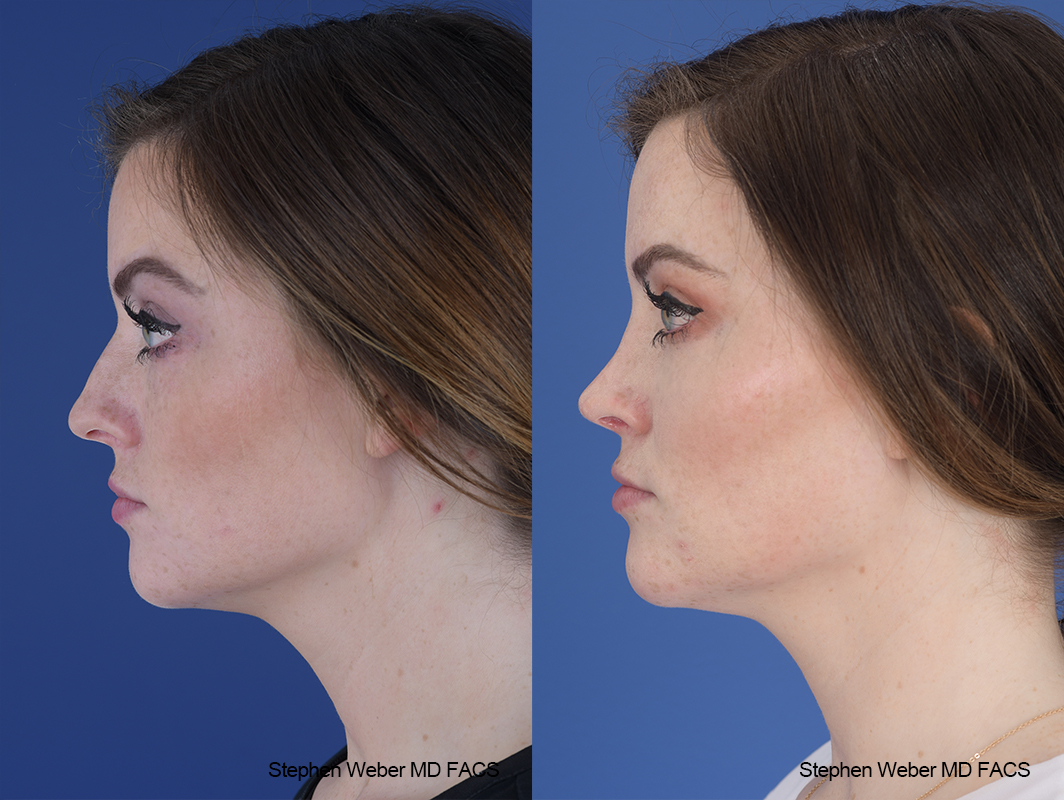 Rhinoplasty Before and After | Weber Facial Plastic Surgery