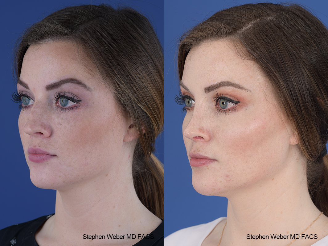 Rhinoplasty Before and After | Weber Facial Plastic Surgery