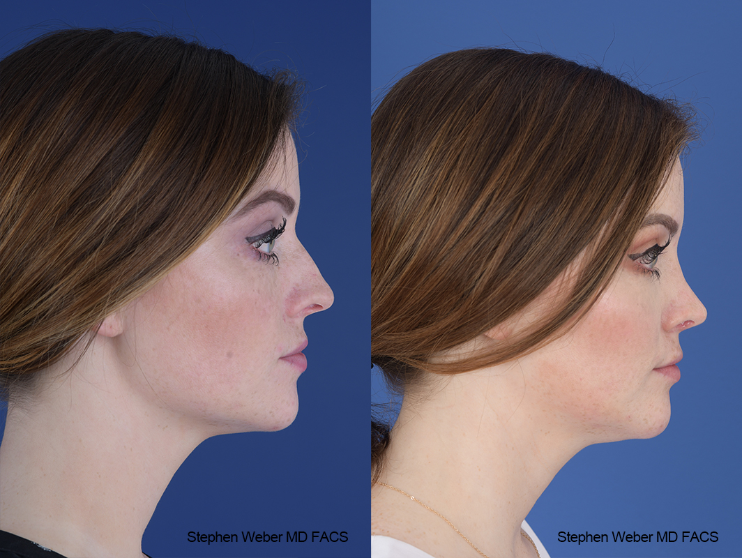 Rhinoplasty Before and After | Weber Facial Plastic Surgery