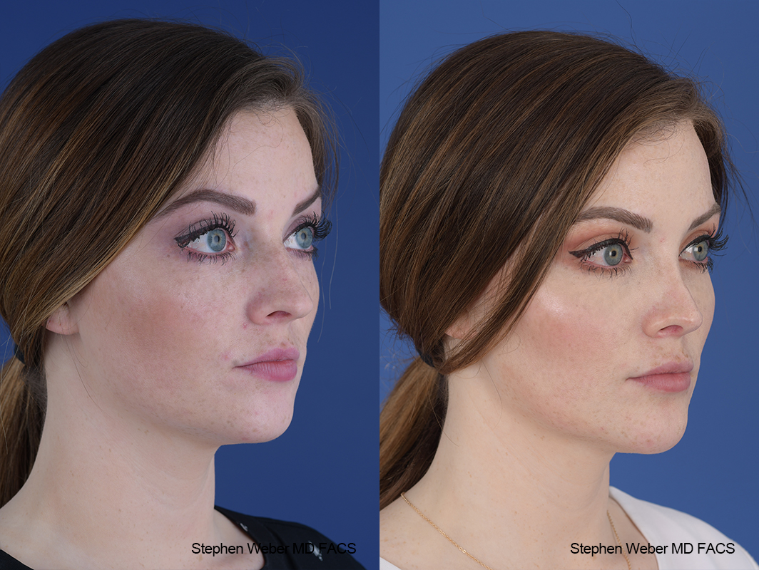 Rhinoplasty Before and After | Weber Facial Plastic Surgery