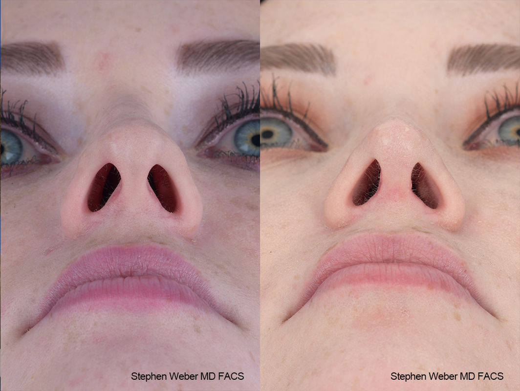 Rhinoplasty Before and After | Weber Facial Plastic Surgery
