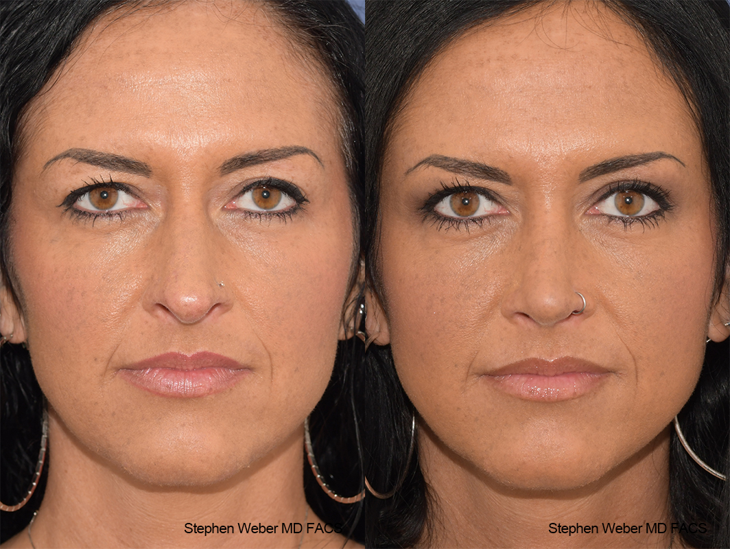 Rhinoplasty Before and After | Weber Facial Plastic Surgery