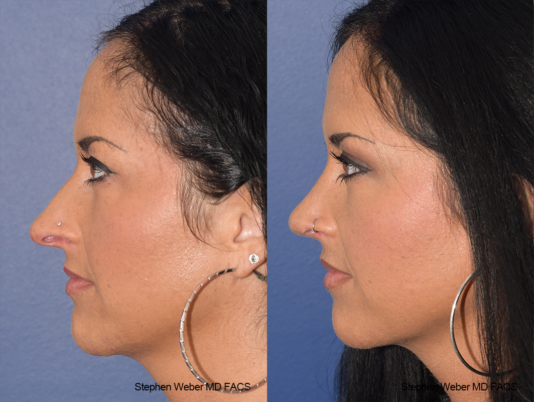 Rhinoplasty Before and After | Weber Facial Plastic Surgery