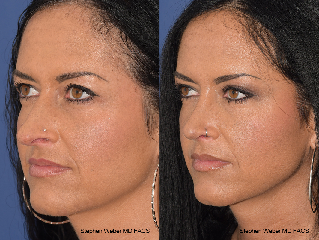 Rhinoplasty Before and After | Weber Facial Plastic Surgery