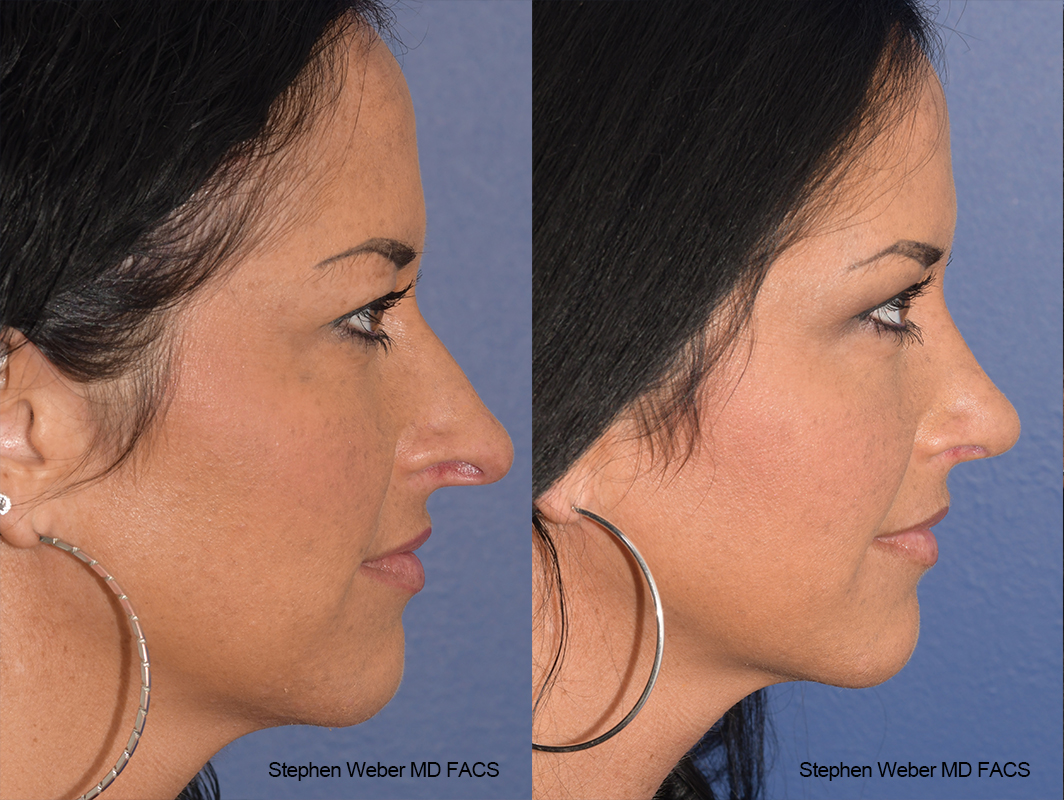 Rhinoplasty Before and After | Weber Facial Plastic Surgery