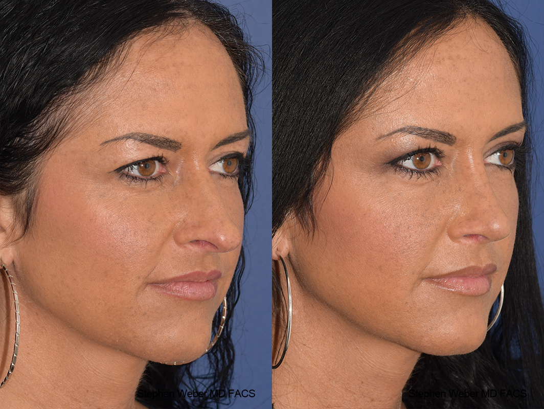 Rhinoplasty Before and After | Weber Facial Plastic Surgery