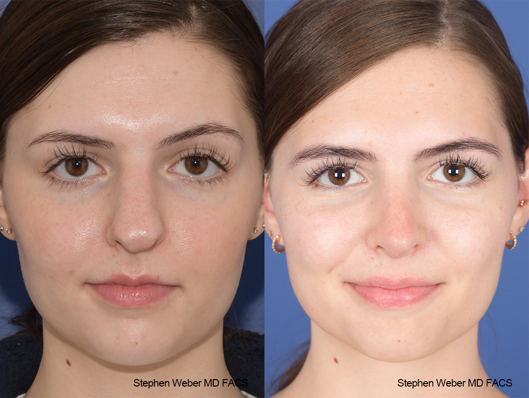 Rhinoplasty Before and After | Weber Facial Plastic Surgery