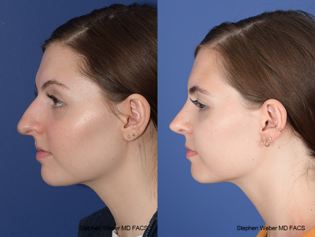 Rhinoplasty Before and After | Weber Facial Plastic Surgery