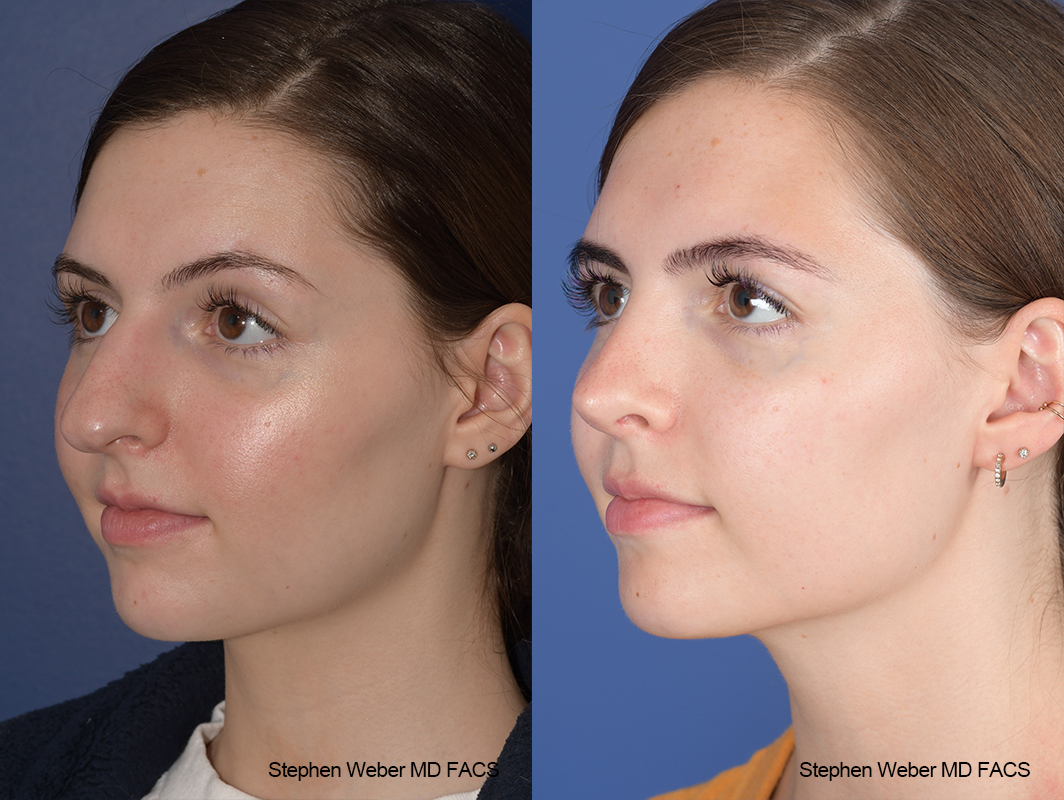 Rhinoplasty Before and After | Weber Facial Plastic Surgery