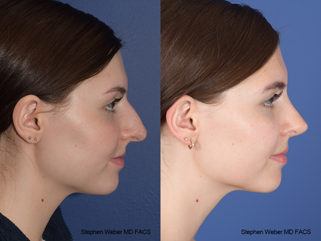 Rhinoplasty Before and After | Weber Facial Plastic Surgery
